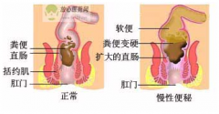 福州便秘用什么药好？