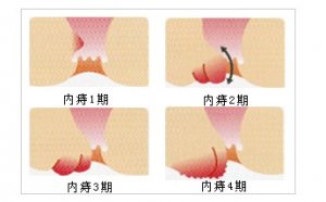 福建协和医院痔疮科