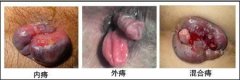 你想不到的痔疮背后的秘密