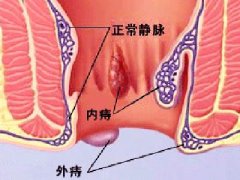 你想不到的痔疮背后的秘密