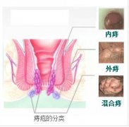 患上痔疮不治疗会有什么危害