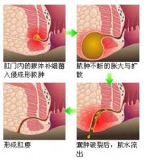 福州女人得了肛瘘去哪个医院治效果果好