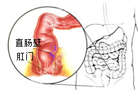 直肠恶变百科