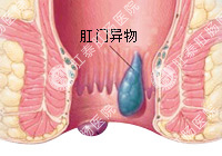 肛门异物百科