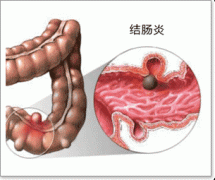 结肠炎示意图