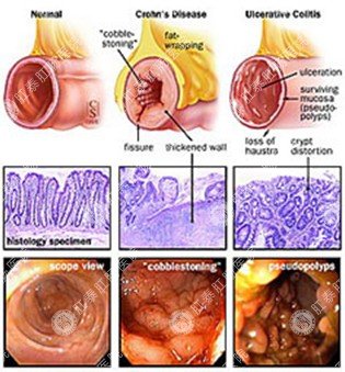 结肠炎症状图解