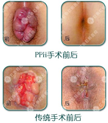 传统手术与肛泰PPH手术前后对比