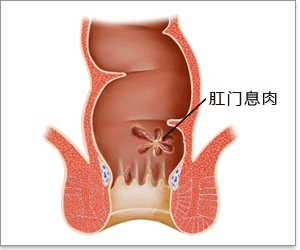 肛门息肉百科