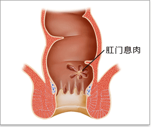 肛门息肉示意图