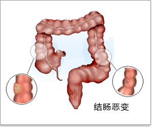 结肠恶变示意图