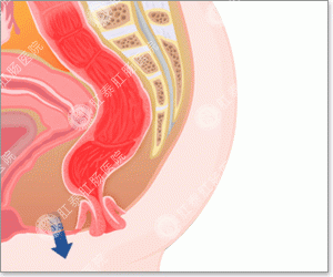 肛门疾病